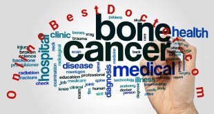 Bone Cancer Causes and Treatment